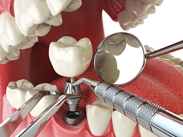 Best Emergency Root Canal Treatment in Quinebaug, CT